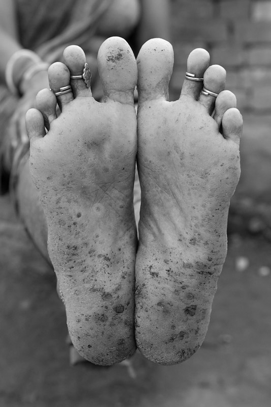 A rural lady suffering from hyperkeratosis on the soles due to consumption of arsenic rich water in Buxar district, Bihar